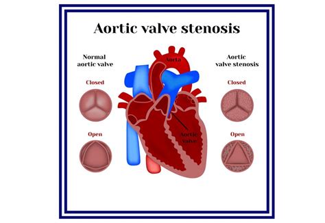 Heres What You Need To Do If You Suffer From Aortic Valve Stenosis