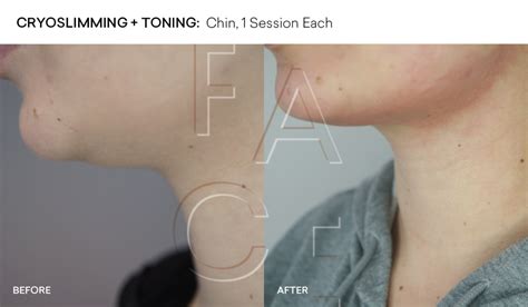 Cryoskin Double Chin Get A Dreamy Jawline With Cryotherapy — Face