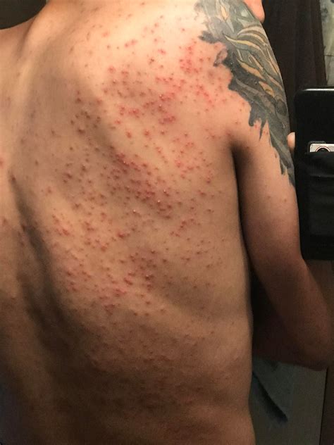 These Bumps Maybe Rash Just Popped Up On My Back Seemingly Out Of No
