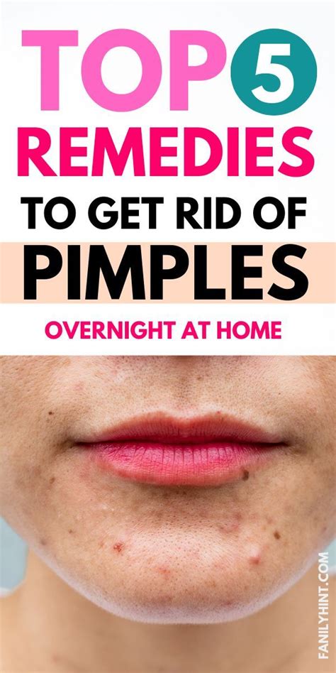 How To Get Rid Of Pimples Overnight 11 Effective Ways Artofit