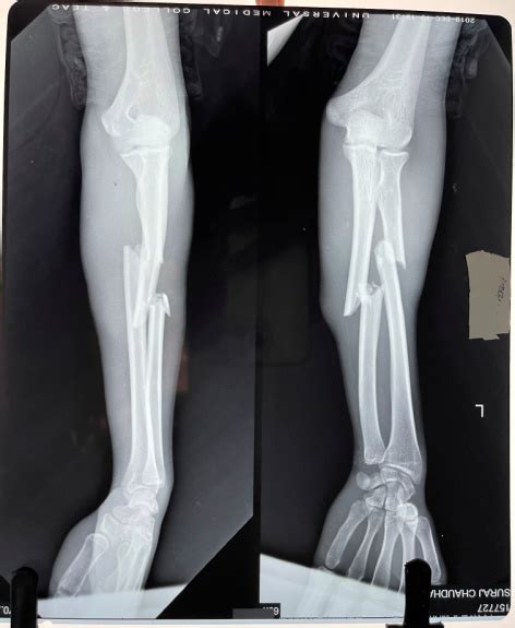 Surgical Outcome Of Forearm Fractures Treated With Titanium Elastic
