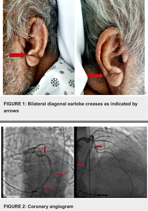 Pdf Diagonal Earlobe Crease A Marker Of Coronary Artery Disease A