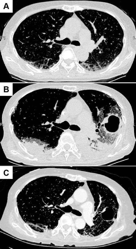 Chest Ct Images In Case 1 A At The Admission Ground Glass Opacity