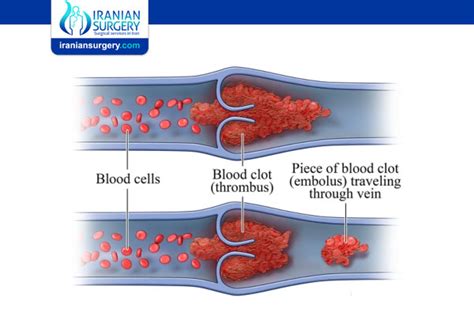 Thrombosis Vs Embolism Iranian Surgery