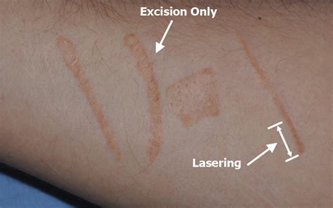 Scar Revision Before And After Images Seattle Bellevue