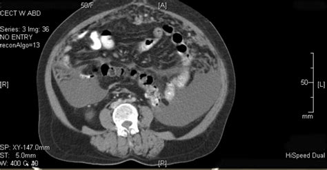 Full Text Primary Serous Carcinoma Of Peritoneum A Case Report