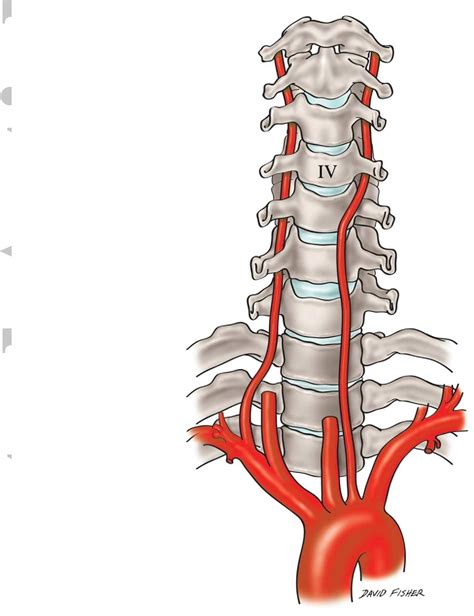 Cervical Vertebral Artery Dissection