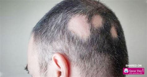 Natural Remedies For Alopecia Areata Hair Loss