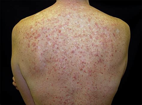 Subacute Cutaneous Lupus Erythematosus Exacerbated Or Induced By Chemotherapy Dermatology