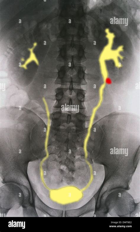 Kidney Stone X Ray Stock Photo Alamy