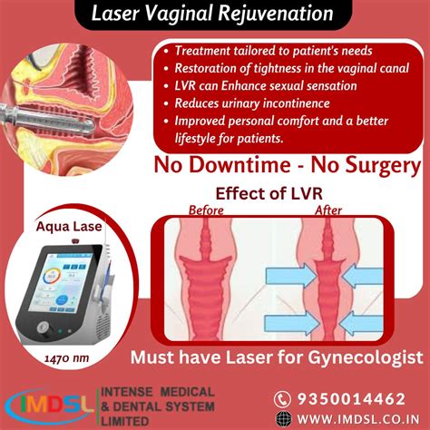 Laser Helping In Cosmetic Gynecology Laser Vaginal Rejuvenation
