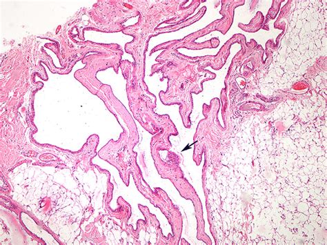 A Case Of Generalised Cutaneous Apocrine Cystomatosis In A Pekingese