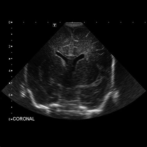 Introduction To Neonatal Cranial Ultrasound Paedshub