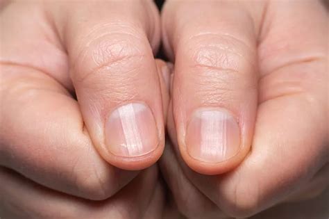 What Ridges In Your Nails Really Mean And When Its Time To Go