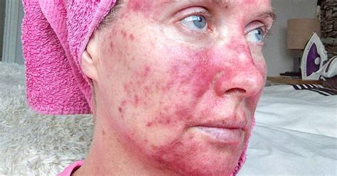 Actinic Keratosis Woman Shows Treatment With Painful Photos