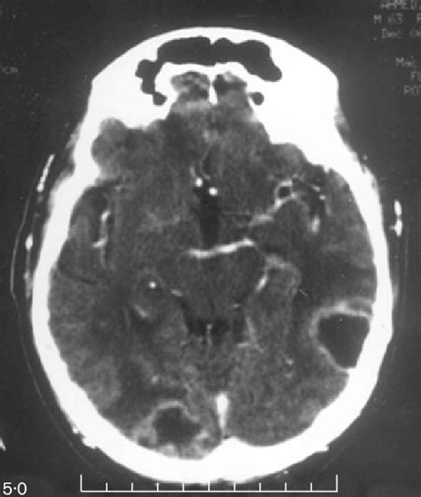 Ct Brain Showing Ring Enhancing Lesions In The Right Occipital And Left