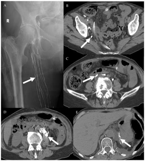 Cancers Free Full Text Oncologic Imaging Of The Lymphatic System