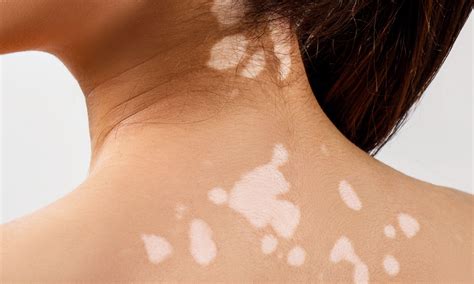 Columbus Skin Discoloration Treatment Eastside Dermatology