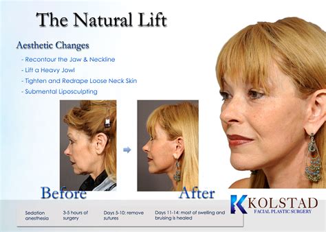 Facelift San Diego Dr Kolstad Facial Plastics Only