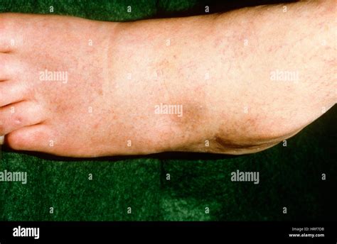 Pitting Edema Of The Foot Stock Photo Alamy