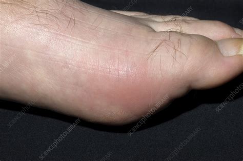 Gout Of The Big Toe Joint Stock Image M1650328 Science Photo Library