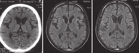 A Computed Tomography Scan Of Brain Showing Cerebral Atrophy And