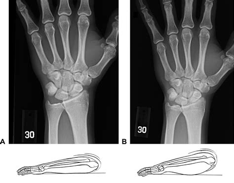 Correlation Of The Lateral Wrist Radiograph To Ulnar Variance A