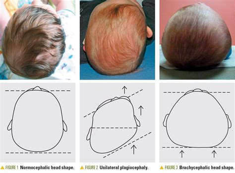 A Pediatric Epidemic Deformational Plagiocephaly Brachycephaly And