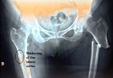 Cureus Bisphosphonates Induced Atypical Subtrochanteric Fracture