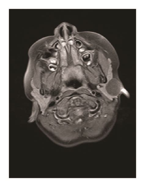 A Coronal Mri Scan Showing A Signal Enrichment In T2 Weighting In The