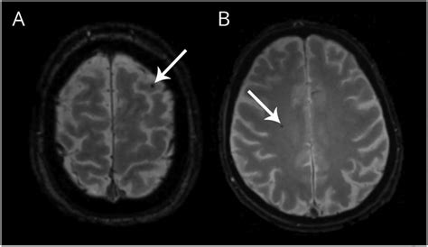 Illustration Of Cerebral Microbleeds In 2 Patients With Download