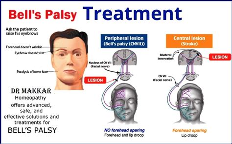 Illustration Showing Facial Paralysis Bell S Palsy Ty