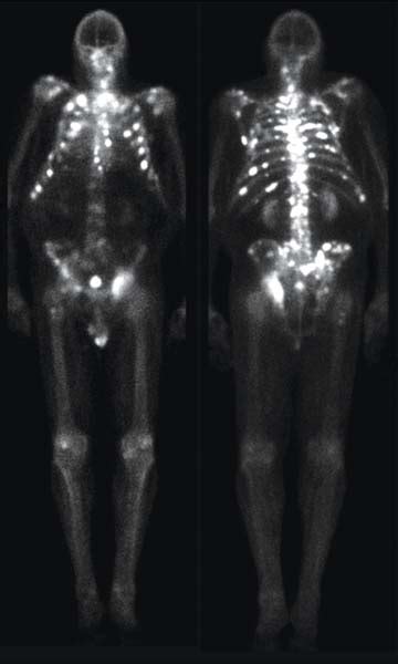 Painful Bone Metastases Radiology Key