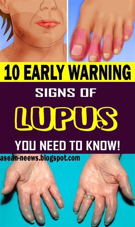 Here Are Early Warning Signs Of Lupus You Need To Know