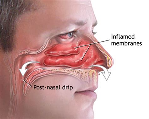 Runny Nose Causes Diagnosis And How To Get Rid Of A Runny Nose
