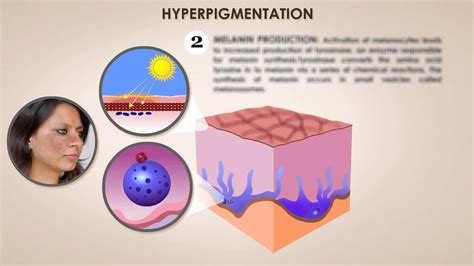 Hyperpigmentation Process Youtube