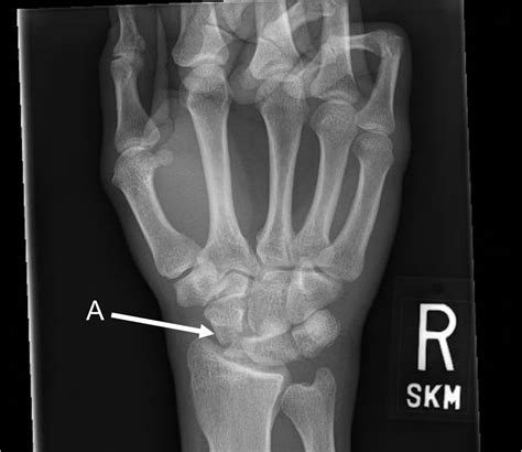 An Isolated Transscaphoid Perilunate Dislocation Resulting From Airbag Deployment Journal Of