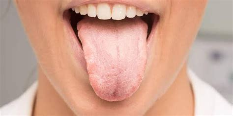 Dry Mouth Symptoms Causes And Treatment Onlymyhealth