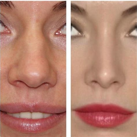 Rhinoplasty Bulbous Nose Reduction Is One Of The Most Commonly