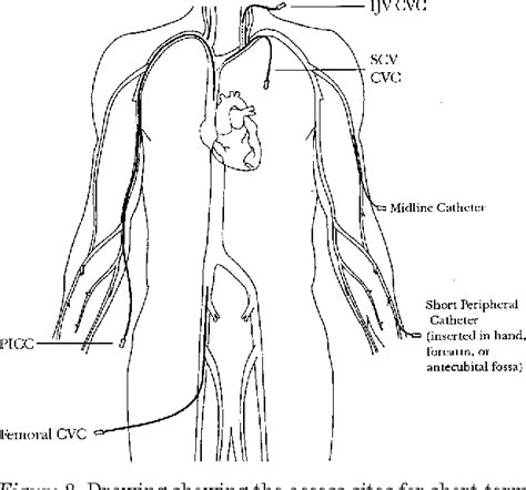 Figure 2 From The Ins And Outs Of Venous Access Part Ii Semantic