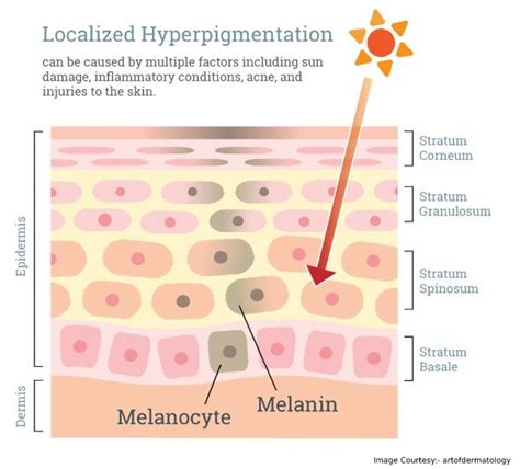 Irritated With Hyperpigmentation Hyperpigmentation Causes And Treatment