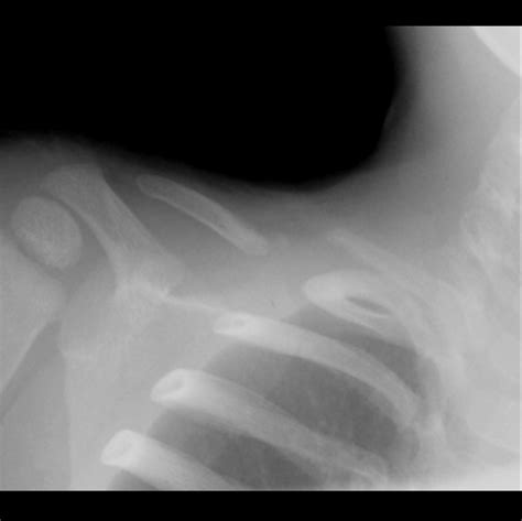 Pseudoarthrosis Of The Clavicle Image