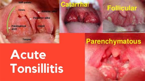 Acute Tonsillitis Ent Dhingra Youtube