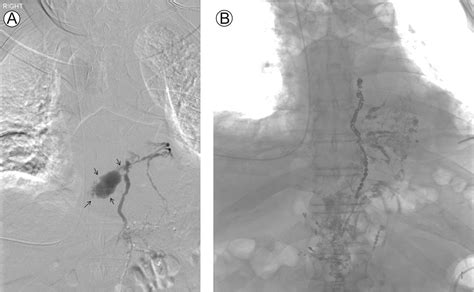 Lymphangiography For Thoracic Duct Interventions Techniques In