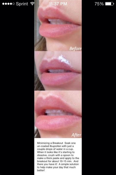 You can get a pimple anywhere, including your face, tongue, lips, etc. Remove A pimple next to lip less than 20 Minutes in 2020 ...