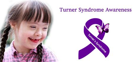 Turner Syndrome Pictures Causes Facts Symptoms Treatment Healthmd My