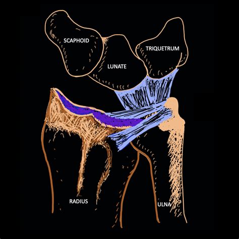 Triangular Fibrocartilage Complex Anatomy Pulse Md
