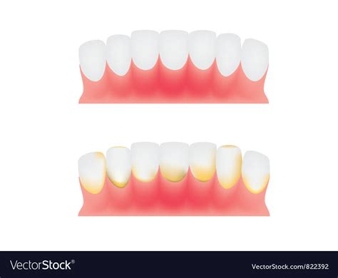 Teeth And Gums Royalty Free Vector Image Vectorstock