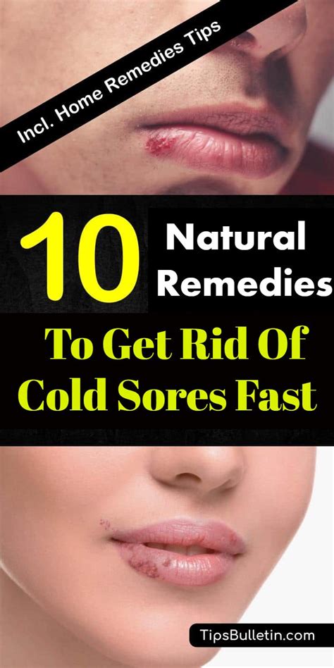 Top 10 Natural Remedies To Get Rid Of Cold Sores Fast Cold Sore Get