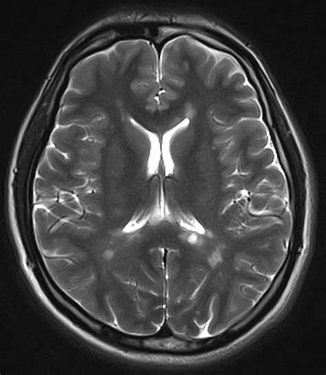 รายการ 93 ภาพ ภาพ Mri สมอง อัปเดต